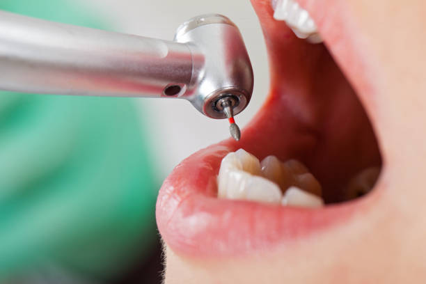 Best Emergency Tooth Extraction in Madison, MS